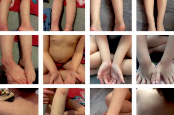 Jak leczę… egzemę