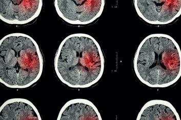 Rehabilitacja po udarze