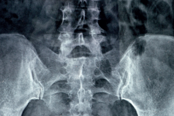 Terapia stawu krzyżowo-biodrowego