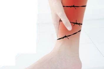 6 sposobów na żylaki