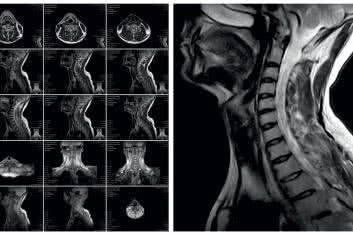 „To SNAG or not to SNAG”