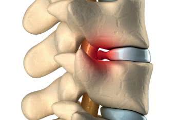 Przepuklina krążka międzykręgowego w odcinku lędźwiowym