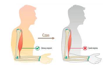 Fizjoterapia w dystrofii mięśniowej. Część 2