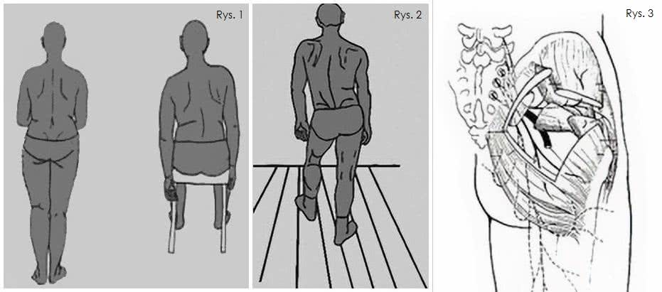 Niestabilność miednicy