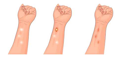 Tłuszczak - co to jest, skąd się bierze? Jak leczyć tłuszczaki 