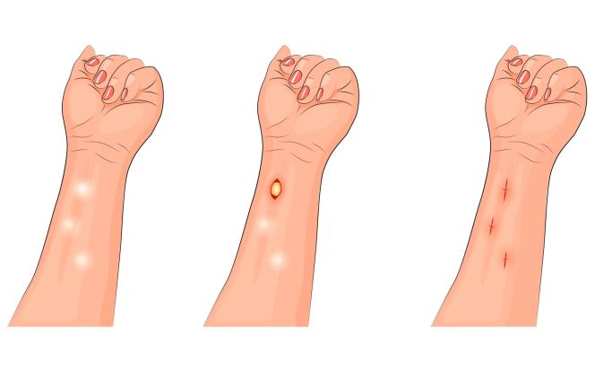 Tłuszczak - co to jest, skąd się bierze? Jak leczyć tłuszczaki 