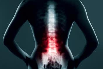 Kinezyterapia odruchowa w zmianach degeneracyjno-‑dystroficznych kręgosłupa 