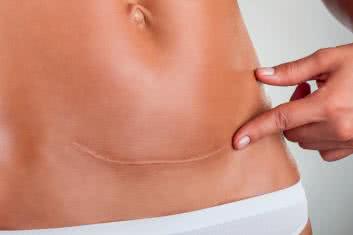 Pooperacyjne zrosty otrzewnowe 