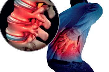 Palący ból pleców Jak różnicować zespoły korzeniowe? 