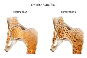 Witamina K czy bisfosfoniany - co pomaga przy osteoporozie?
