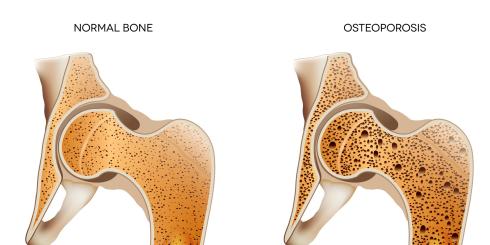 Witamina K czy bisfosfoniany - co pomaga przy osteoporozie?