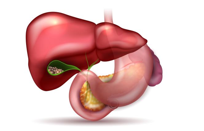 Kamica żółciowa - objawy, przyczyny i leczenie