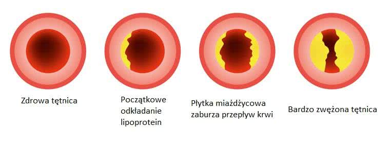 Zmiany miażdżycowe w tętnicach
