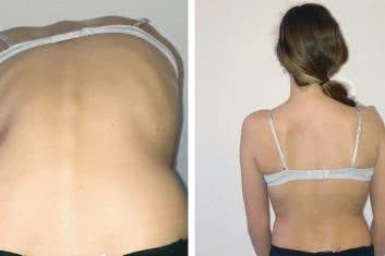 Skolioza i osteopatia część 2: terapia osteopatyczna