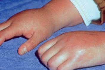 Kompleksowy zespół bólu regionalnego (CRPS) a reorganizacja korowa