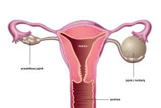 Torbiel na jajniku - diagnoza, objawy i usunięcie