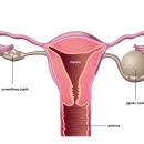 Torbiel na jajniku - diagnoza, objawy i usunięcie