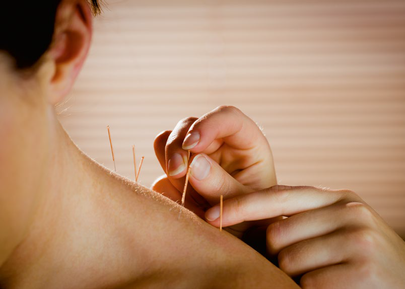 Akupunktura