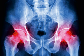 Boli mnie noga w biodrze...