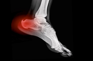 Porady z notatnika Starego Doktora - Ostroga piętowa