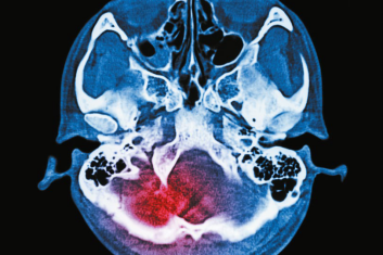 Rehabilitacja i poprawa stanu pacjenta po urazowym uszkodzeniu mózgu