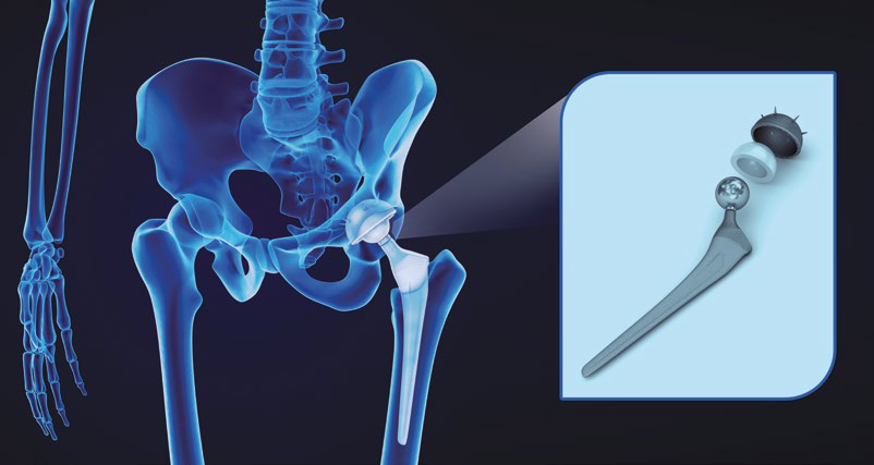 Proteza stawu biodrowego