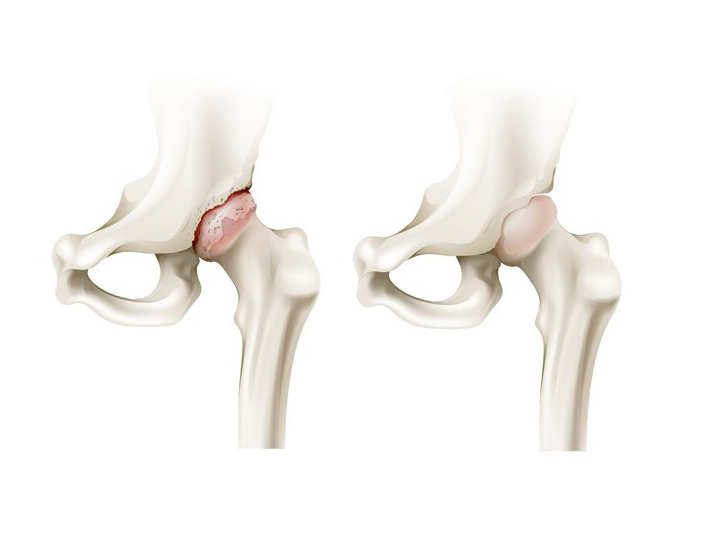 Grafika przedstawiająca chory i zdrowy staw biodrowy