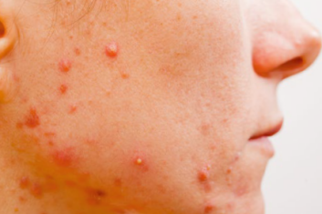 trądzikiem dorosłych