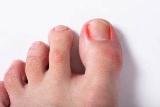Wrastające paznokcie – przyczyny, objawy, leczenie, domowe sposoby