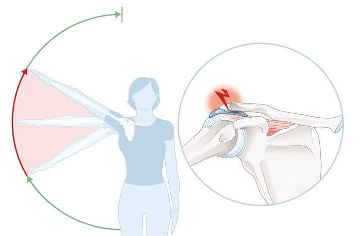 Zespól ciasnoty barkowej