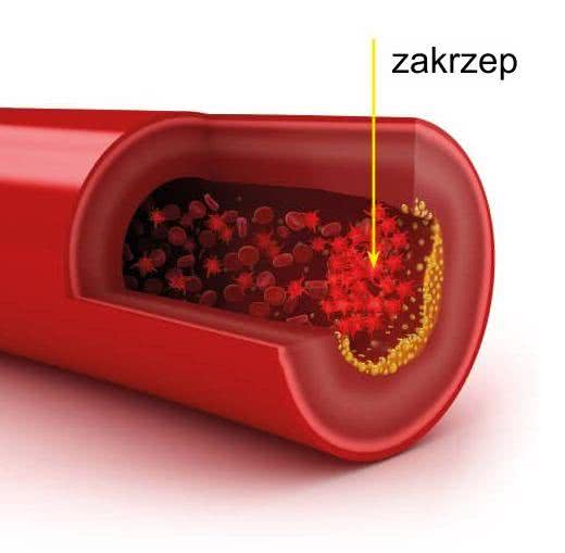 Zakrzep