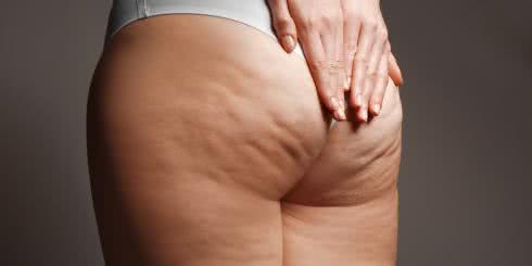 Jakie zabiegi na cellulit na udach i brzuchu? Suplementy, naturalne sposoby i nie tylko