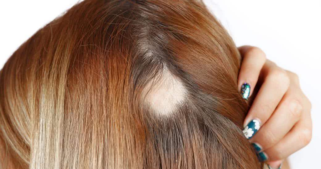 Łysienie Plackowate Przyczyny Objawy Diagnostyka I Leczenie Alopecji Oczymlekarzepl 7222