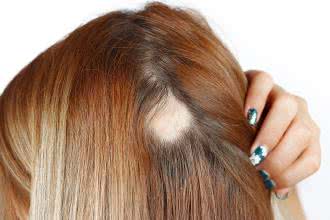 Łysienie plackowate - przyczyny, objawy, diagnostyka i leczenie alopecji 