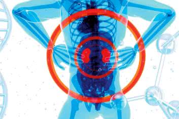 11 sposobów na kamienie nerkowe