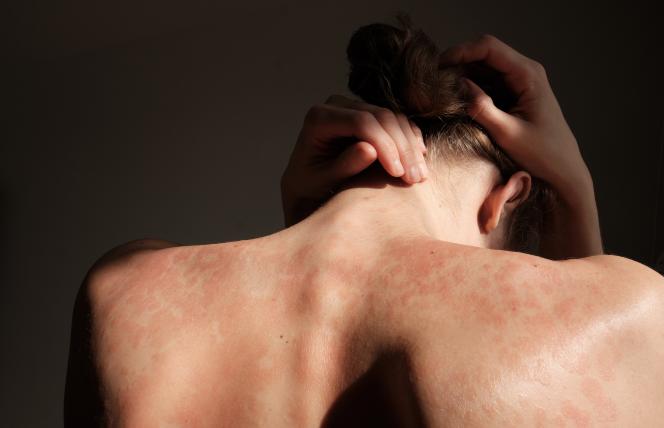 Jak pozbyć się pokrzywki w szybki i naturalny sposób?