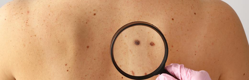 Nowotwór skóry to nie wyrok!