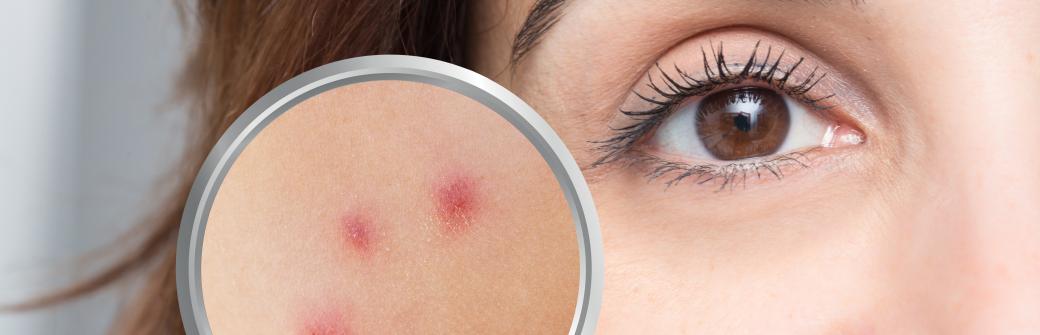 Wygląda jak trądzik, ale jest o wiele niebezpieczniejszy. Tak pajęczak atakuje skórę