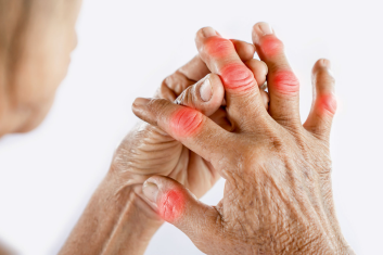 Zastosowanie pól magnetycznych w leczeniu pacjentów z reumatoidalnym zapaleniem stawów