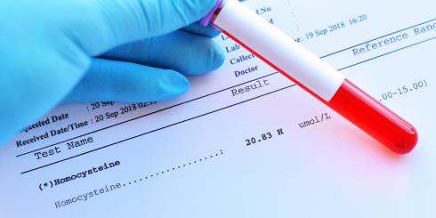 Wysoki poziom homocysteiny - bagatelizowane zagrożenie