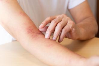 Półpasiec - homeopatyczne leki łagodzące objawy choroby