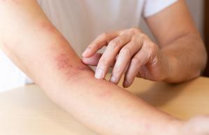 Półpasiec - homeopatyczne leki łagodzące objawy choroby