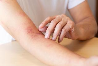 Półpasiec - homeopatyczne leki łagodzące objawy choroby