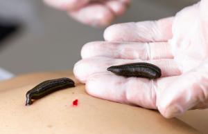 Hirudoterapia to nie wszystko. Poznaj 5 rewolucyjnych terapii naturalnych