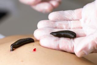 Hirudoterapia to nie wszystko. Poznaj 5 rewolucyjnych terapii naturalnych