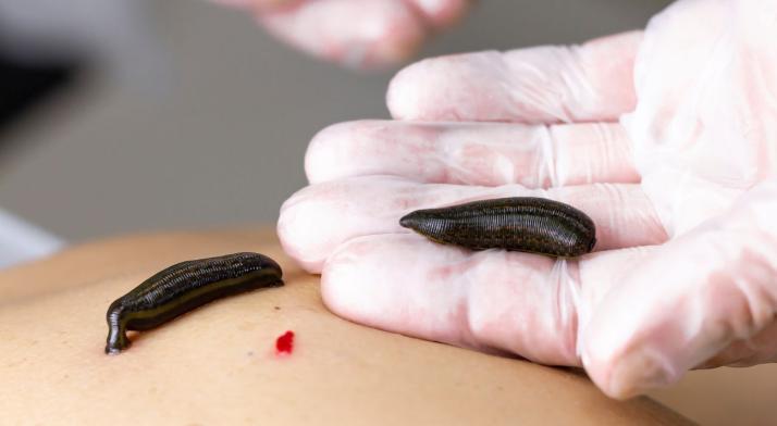 Hirudoterapia to nie wszystko. Poznaj 5 rewolucyjnych terapii naturalnych