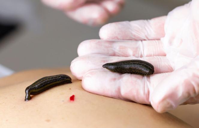 Hirudoterapia to nie wszystko. Poznaj 5 rewolucyjnych terapii naturalnych