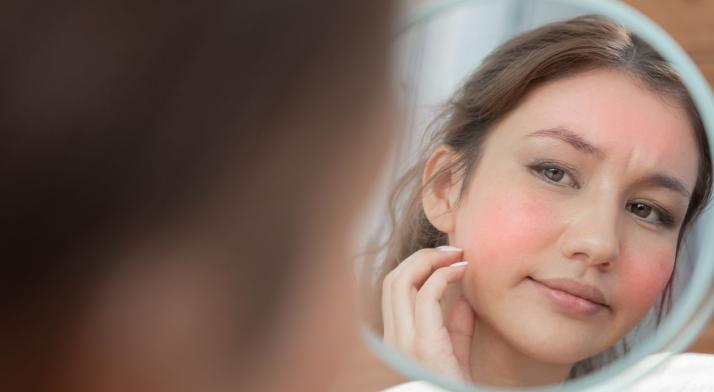 Rumień na twarzy - jak powstaje i jak sobie z nim radzić naturalnymi sposobami?