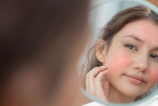 Rumień na twarzy - jak powstaje i jak sobie z nim radzić naturalnymi sposobami?